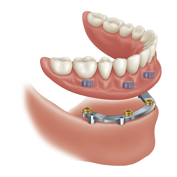 BAR ATTACHMENT