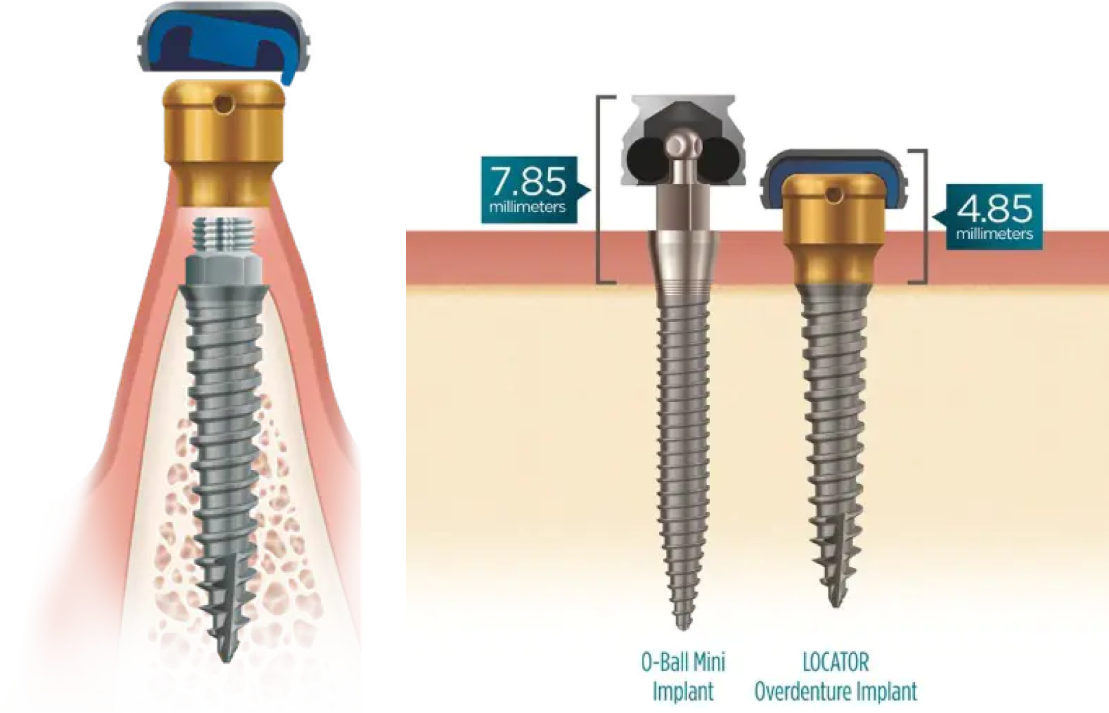 LOCATOR OVERDENTURE IMPLANT SYSTEM