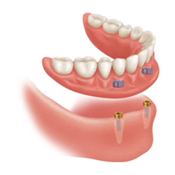 ROOT ATTACHMENT